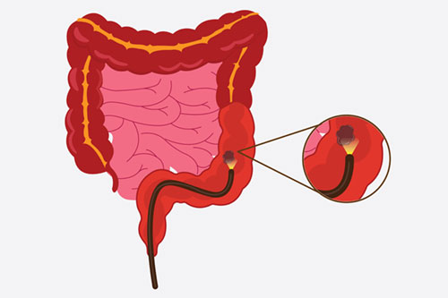 Colonoscopy