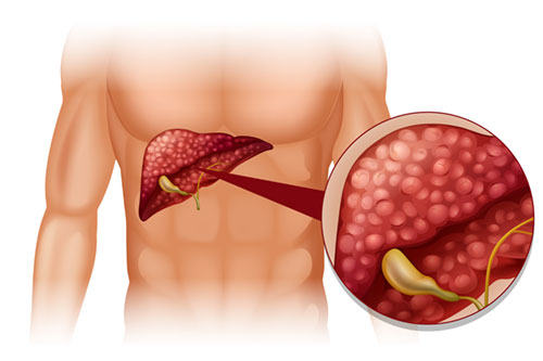 ERCP