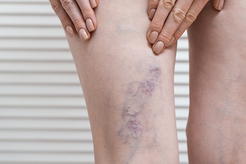Do Not Ignore Varicose Veins